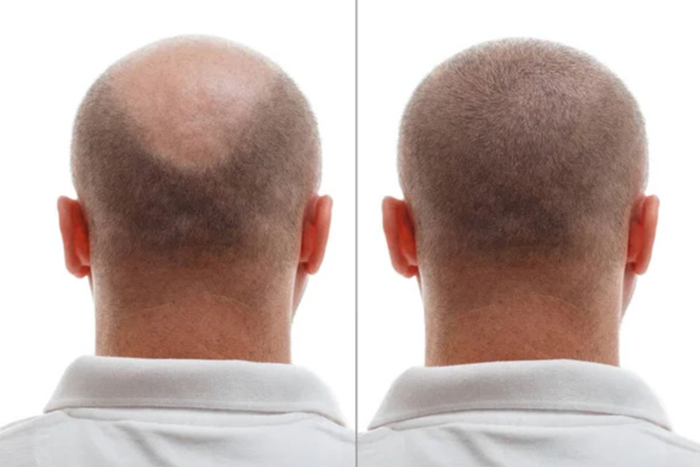 Can You Wear A Hat After A Hair Transplant?